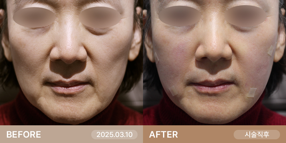 볼륨필러 | 미담의원