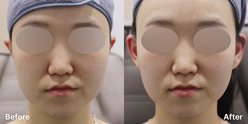 요정귀 필러 | 미담의원