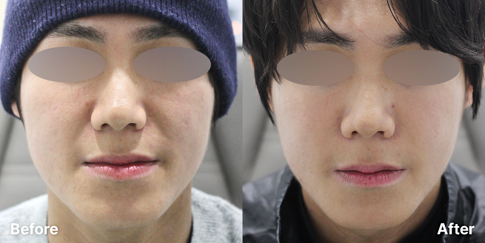 팔자 인디언 | 미담의원