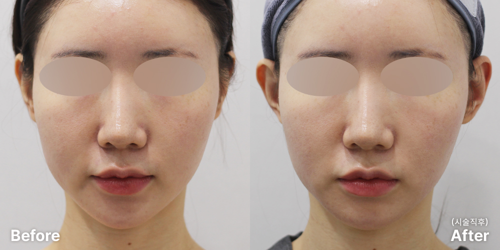 요정귀 필러 | 미담의원