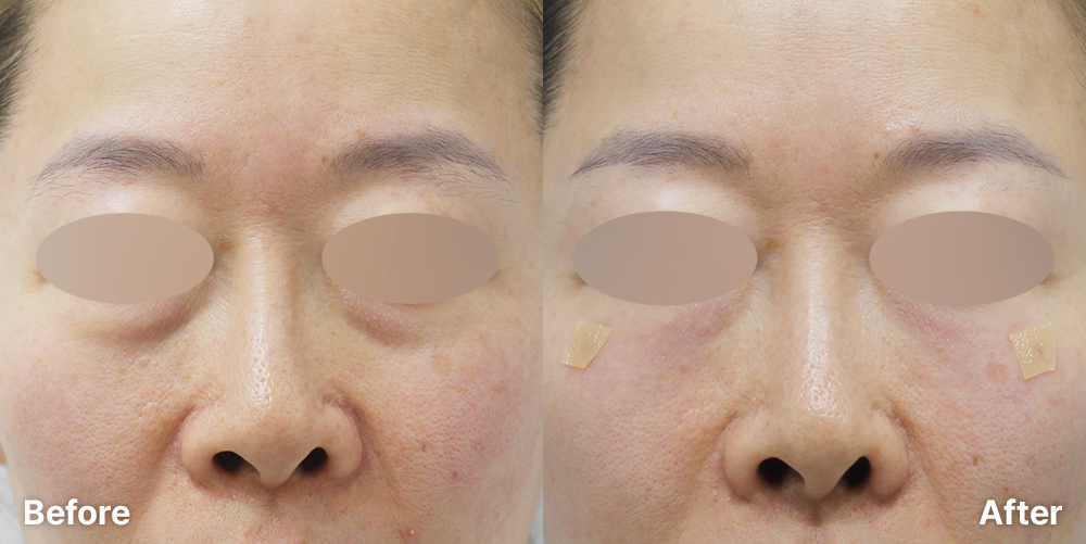 눈밑필러 | 미담의원