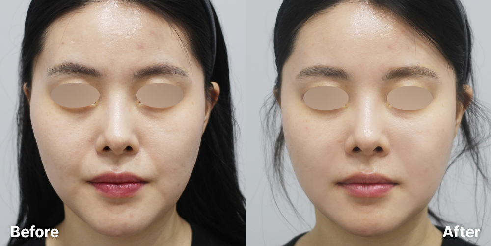 볼륨리프팅 | 미담의원